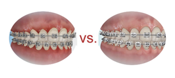 Clean teeth comparison